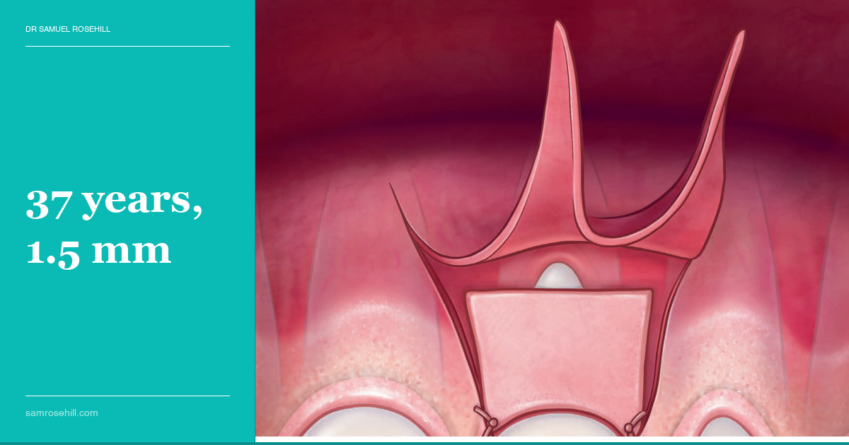 A Connective Tissue Graft, 37 Years Later
